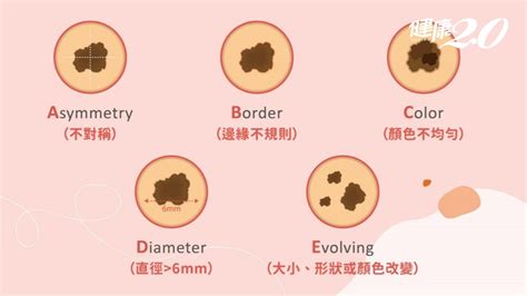 睪丸 黑痣|別把癌當痣！5部位冒黑點恐是惡性黑色素瘤 台大醫師。